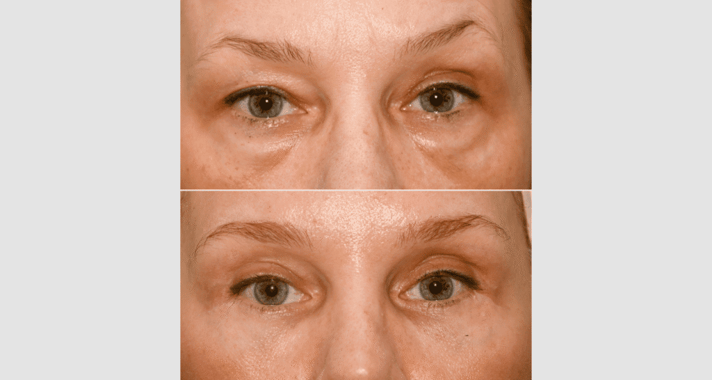 Vorher/Nachher Ergebnis: Oberlid Unterlidstaffung