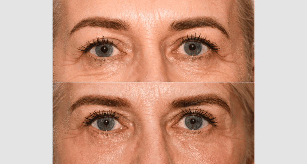 Vorher/Nachher Ergebnis: Oberlid Unterlidstaffung