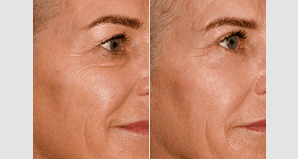 Vorher/Nachher Ergebnis: Oberlid Unterlidstaffung