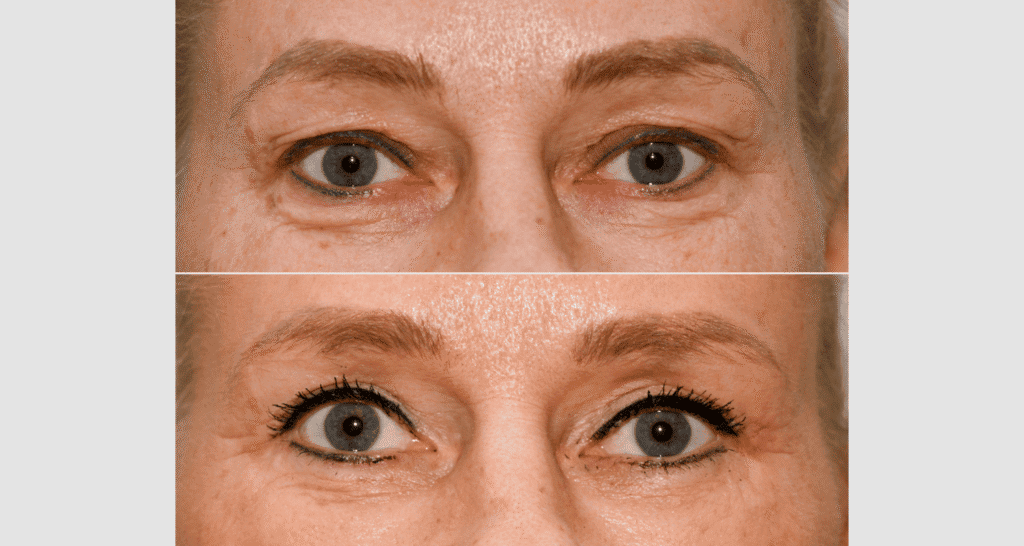Vorher/Nachher Ergebnis: Oberlid Unterlidstaffung