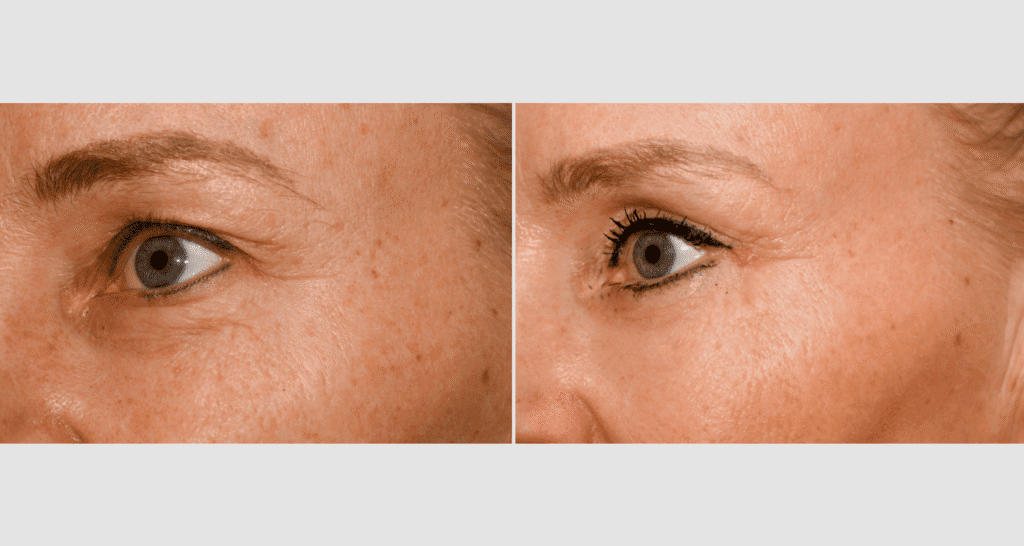 Vorher/Nachher Ergebnis: Oberlid Unterlidstaffung