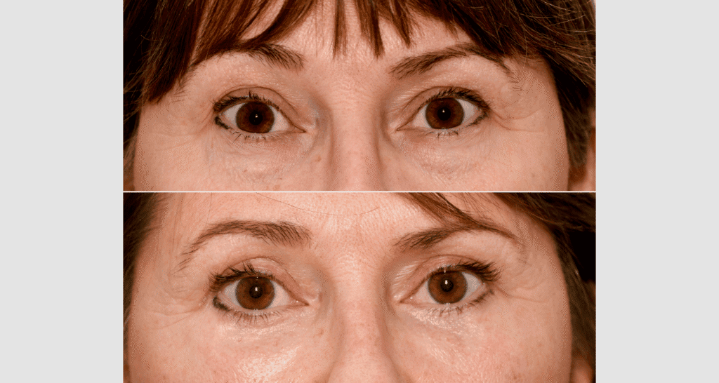 Vorher/Nachher Ergebnis: Oberlid Unterlidstaffung