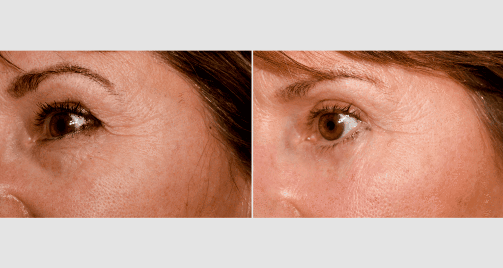 Vorher/Nachher Ergebnis: Oberlid Unterlidstaffung
