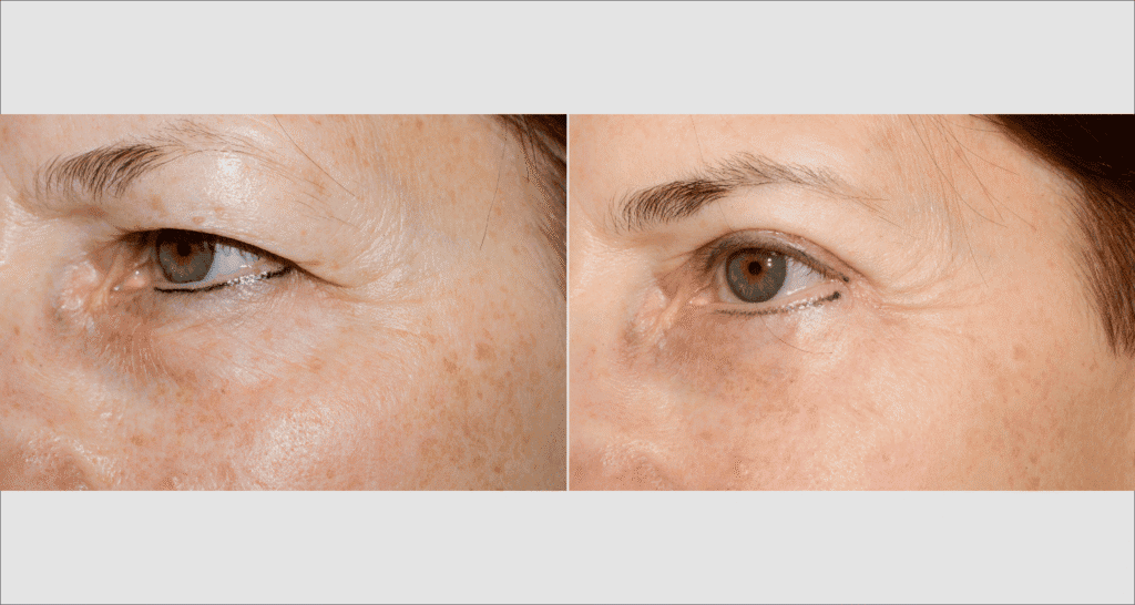 Vorher/Nachher Ergebnis: Oberlid Unterlidstaffung