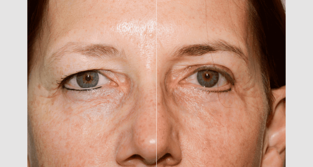 Vorher/Nachher Ergebnis: Oberlid Unterlidstaffung