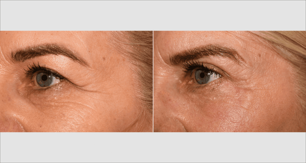 Vorher/Nachher Ergebnis: Oberlid Unterlidstaffung