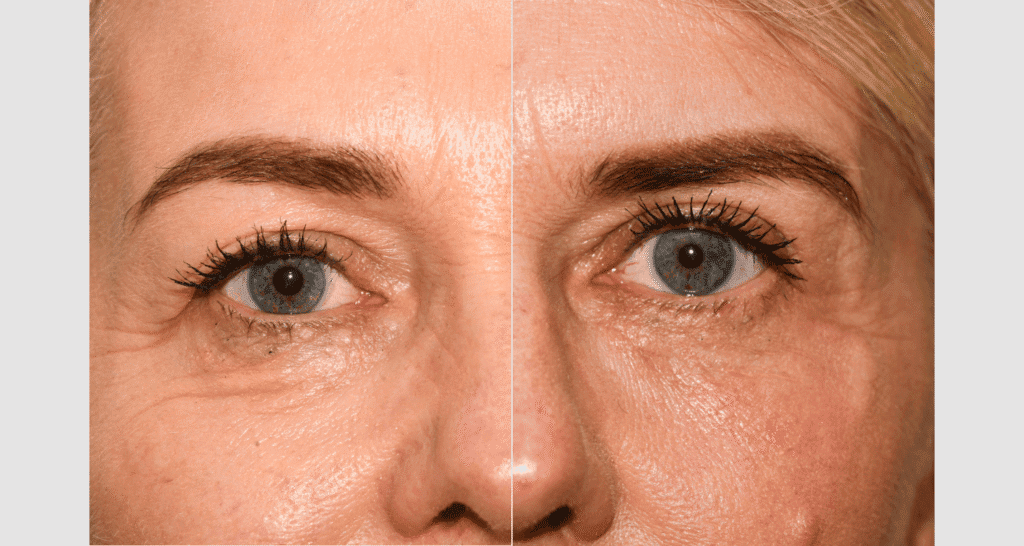 Vorher/Nachher Ergebnis: Oberlid Unterlidstaffung