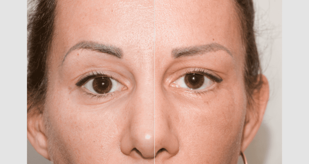 Vorher-Nachher Vergleich der Hautverjüngung bei Frau.