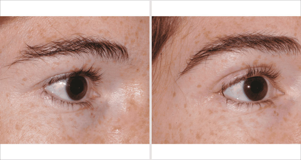 Vergleich der Haut vor und nach einer Hautbehandlung, sichtbare Verbesserung der Hautstruktur.