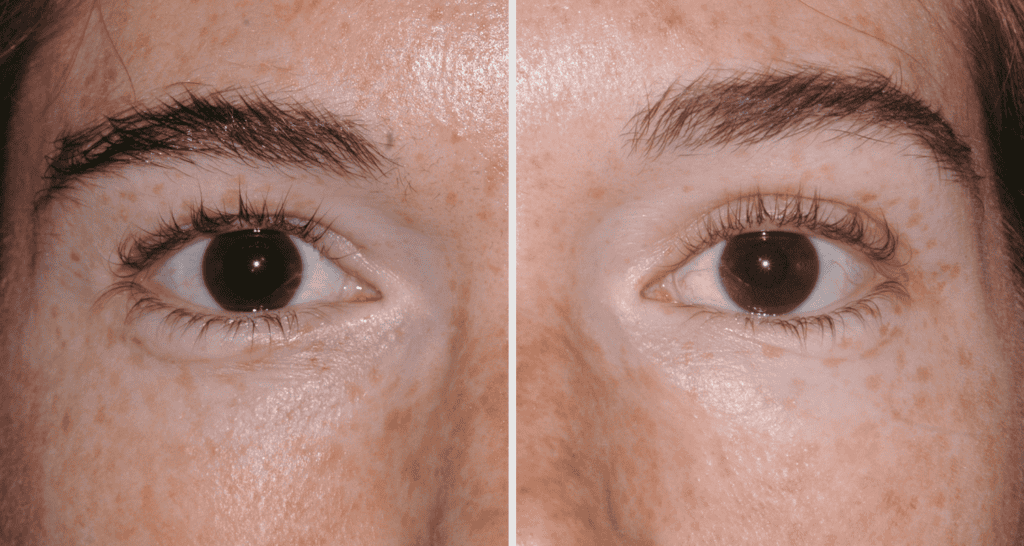 Vorher-Nachher Vergleich der Hautstraffung bei Hautverjüngung.