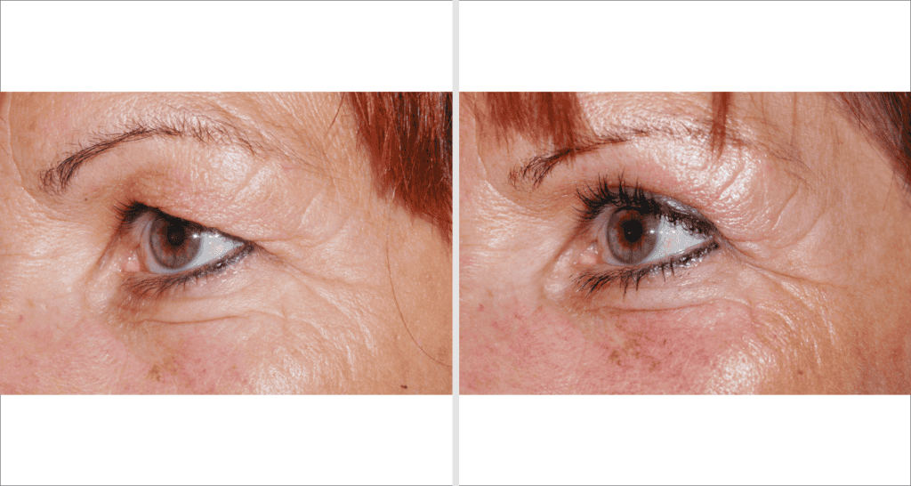 Nahaufnahme eines älteren Auges vor und nach einer Behandlung.