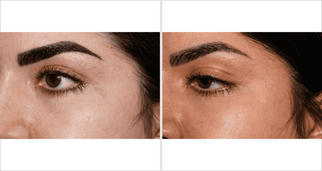 Nahaufnahme eines Gesichts vor und nach Aknebehandlung, Hautverbesserung sichtbar.