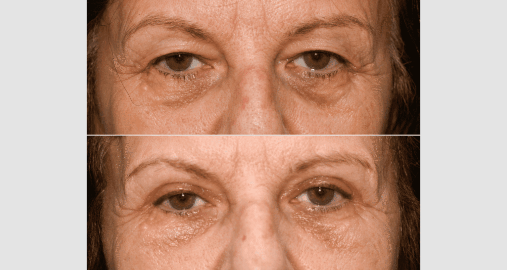 Nahaufnahme des Gesichts einer älteren Frau mit sichtbaren Hautfalten und Textur.