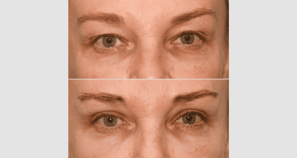 Nahaufnahme von Hautverjüngung, Vorher-Nachher-Vergleich.