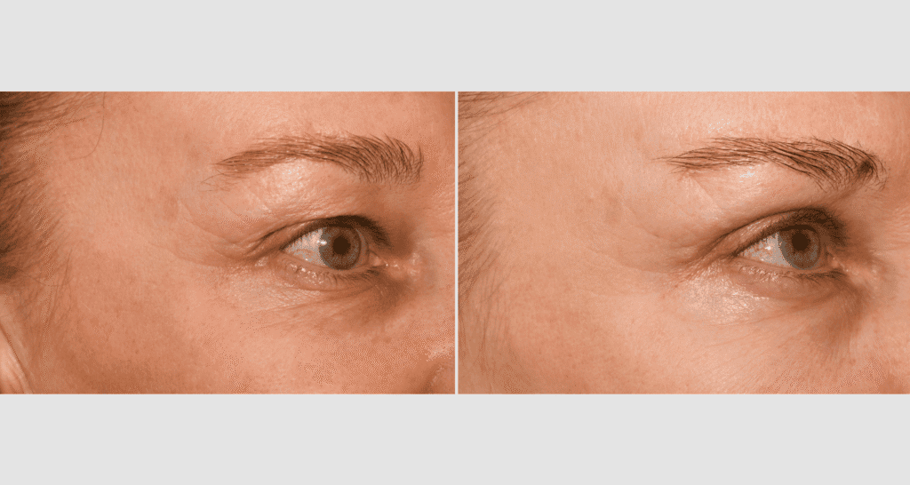 Nahaufnahme eines Gesichts vor und nach Hautbehandlung, Fokus auf Augenpartie.