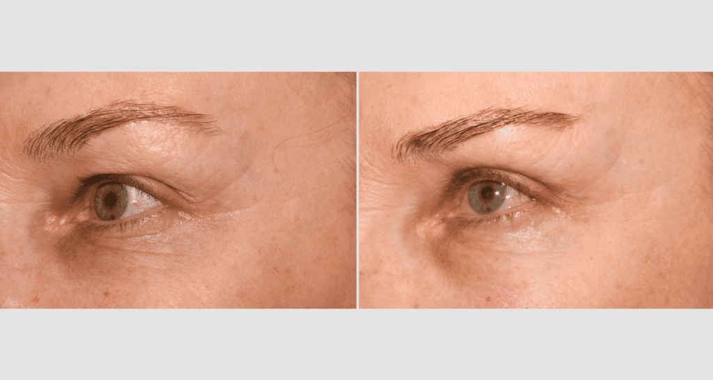 Nahaufnahme eines Auges mit Hautverjüngung vor und nach der Behandlung.