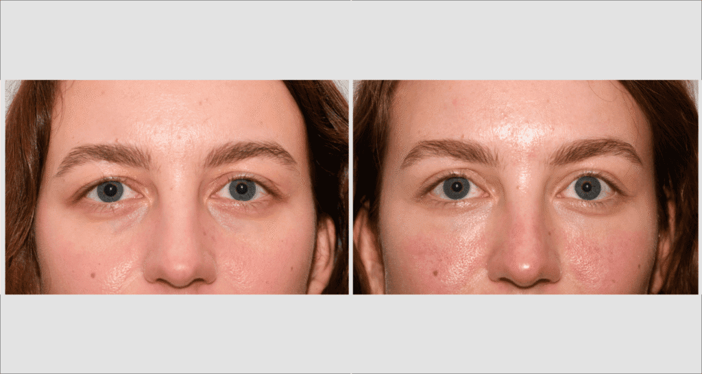 Vergleich von Haut vor und nach Aknebehandlung, Hautbild verbessert sich deutlich.
