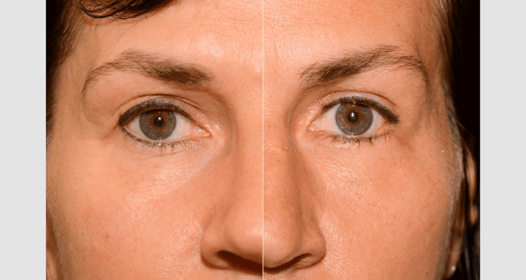 Vorher-Nachher Vergleich der Hautstraffung im Gesicht.