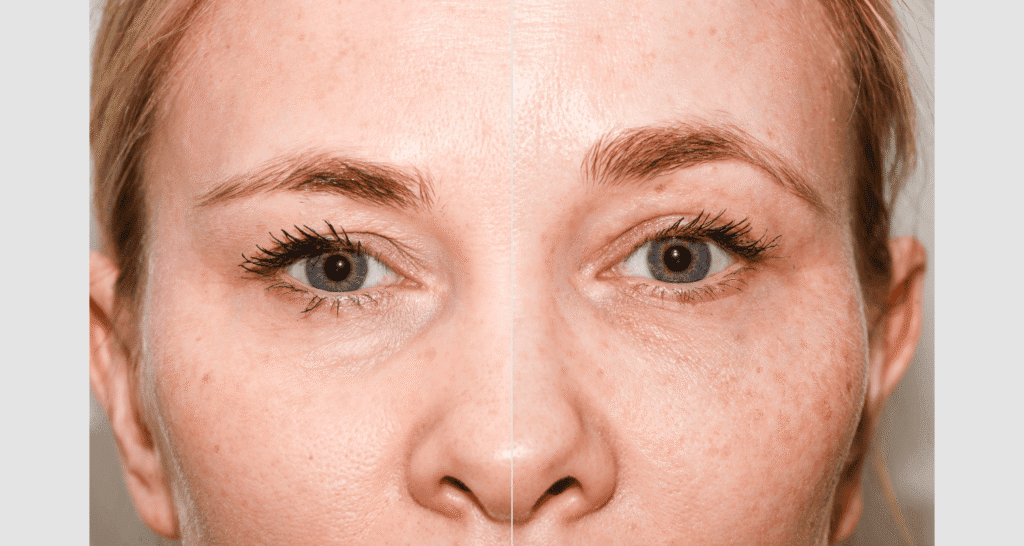 Vergleich von Haut vor und nach einer dermatologischen Behandlung.