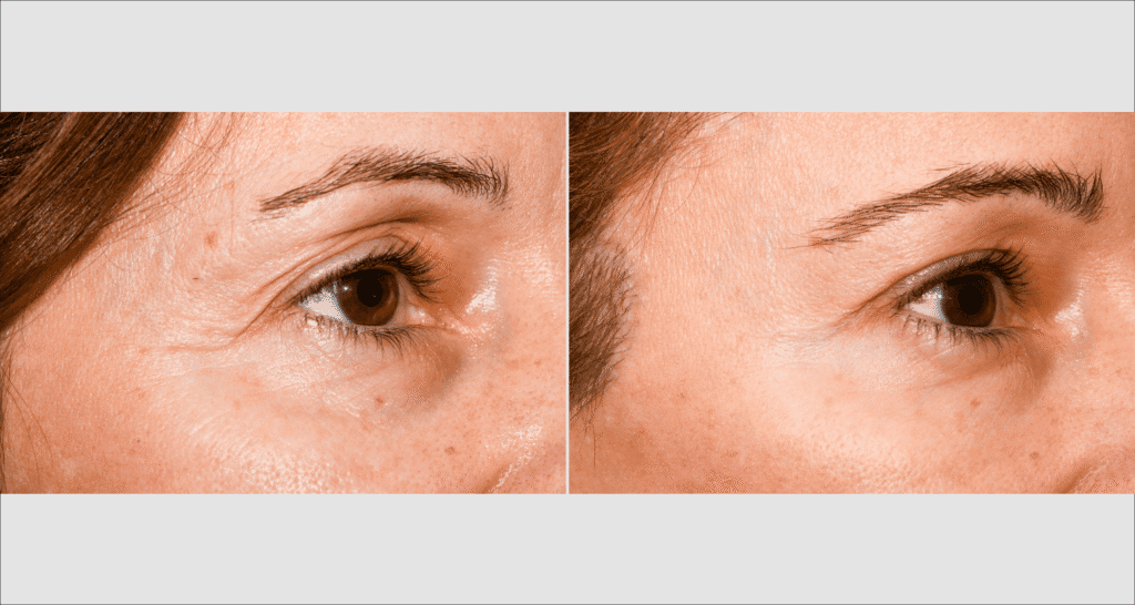 Close-up of eye area showing skin improvement after rejuvenation treatment.