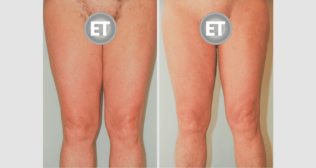 Vorher/Nachher Ergebnis: Oberschenkelstraffung