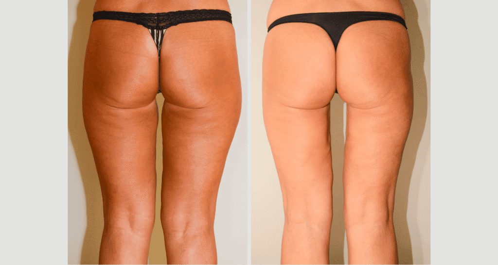 Vorher/Nachher Ergebnis: Oberschenkelstraffung