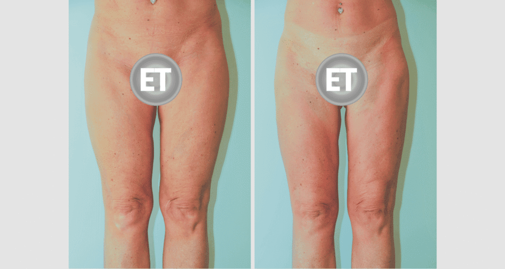 Vorher/Nachher Ergebnis: Oberschenkelstraffung