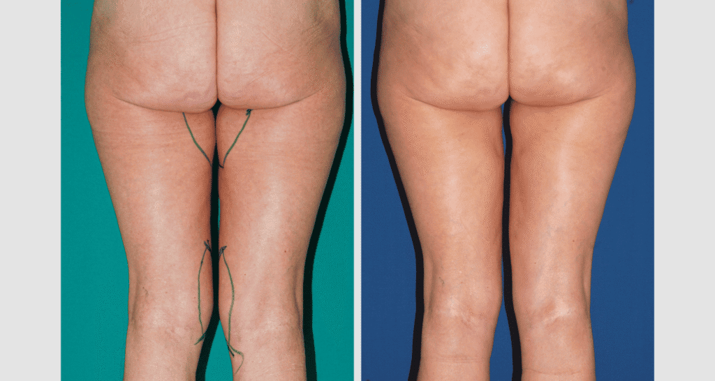Vorher/Nachher Ergebnis: Oberschenkelstraffung