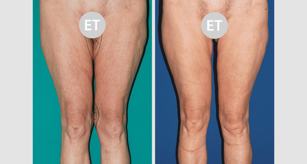 Vorher/Nachher Ergebnis: Oberschenkelstraffung