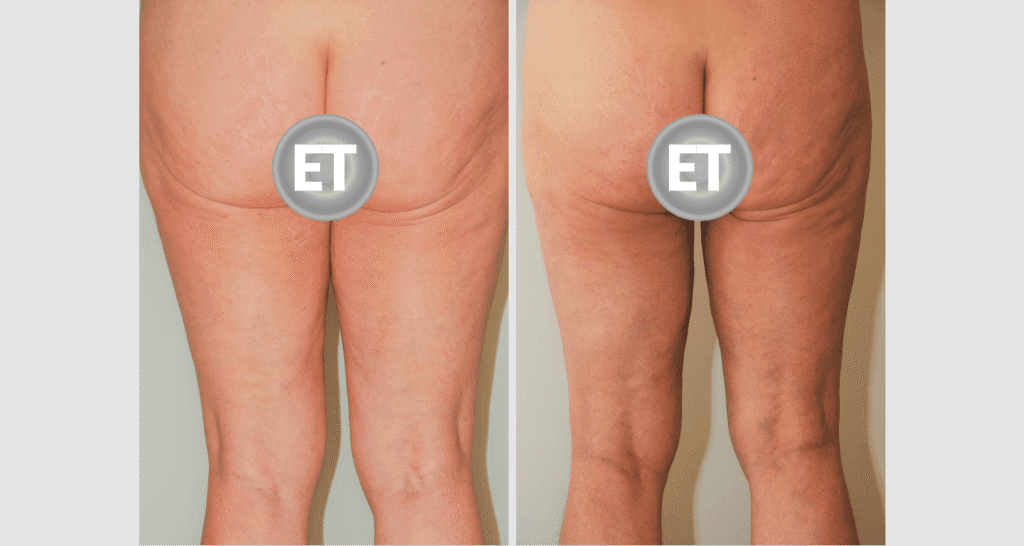 Vorher/Nachher Ergebnis: Oberschenkelstraffung