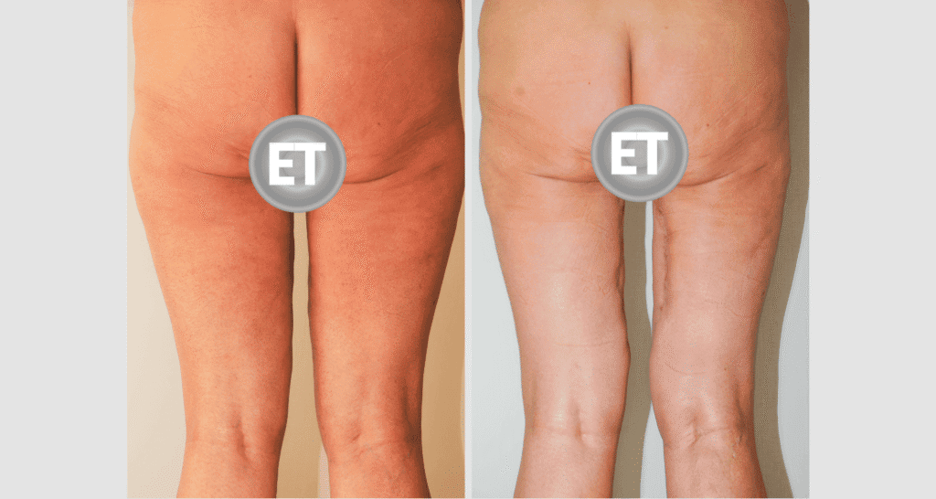 Vorher/Nachher Ergebnis: Oberschenkelstraffung