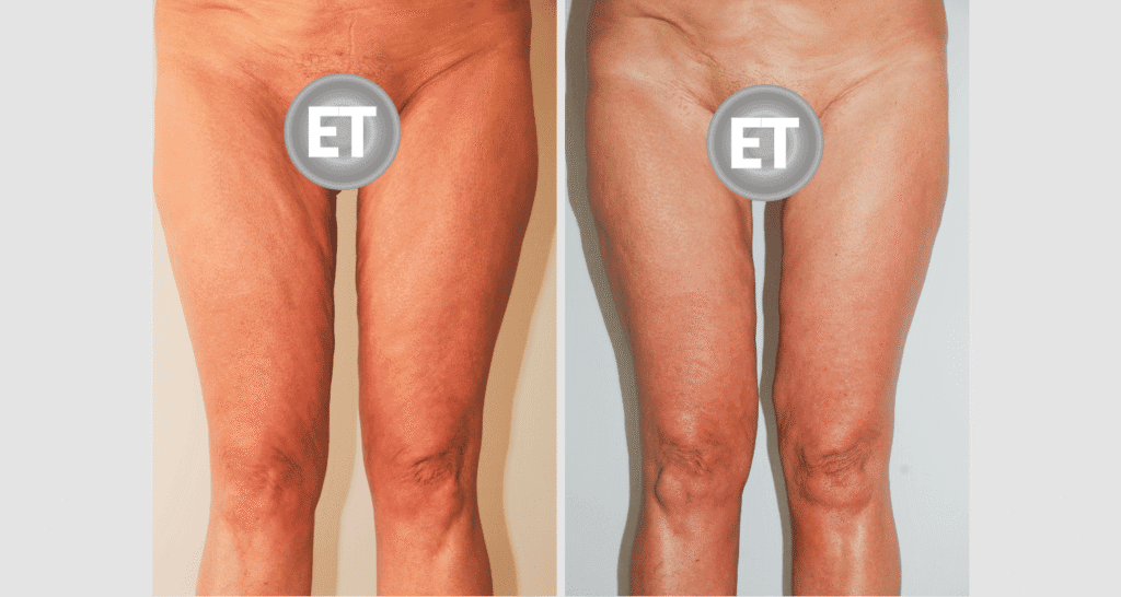 Vorher/Nachher Ergebnis: Oberschenkelstraffung