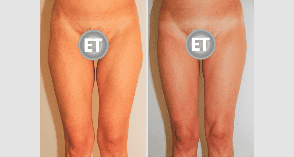 Vorher/Nachher Ergebnis: Oberschenkelstraffung