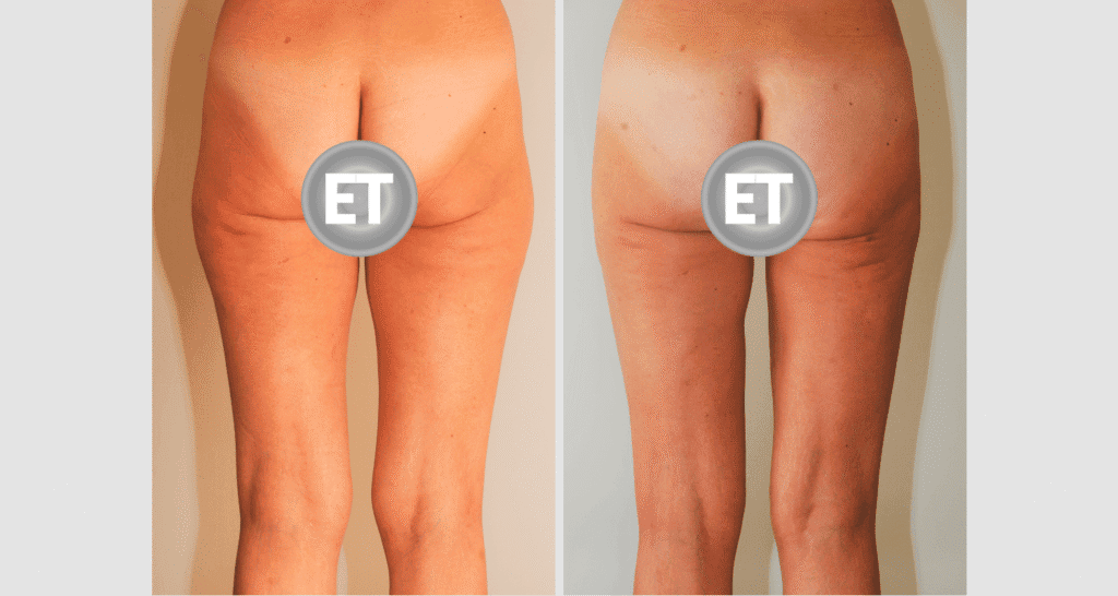 Vorher/Nachher Ergebnis: Oberschenkelstraffung