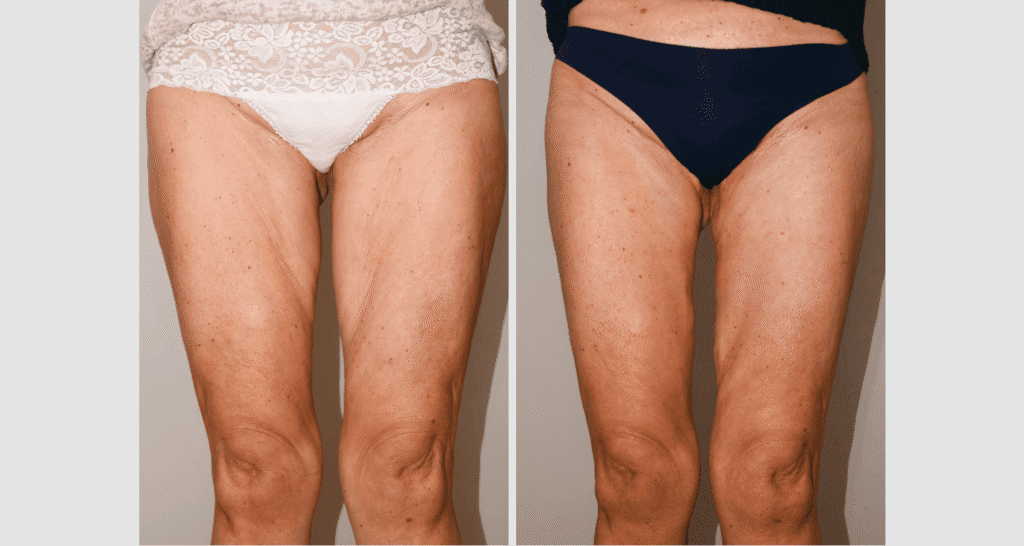 Vorher/Nachher Ergebnis: Oberschenkelstraffung