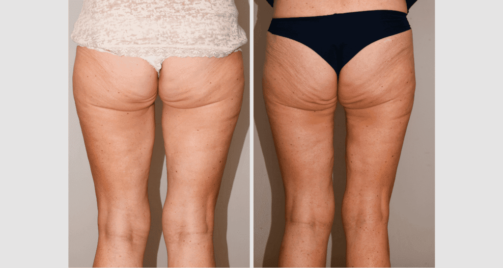 Vorher/Nachher Ergebnis: Oberschenkelstraffung