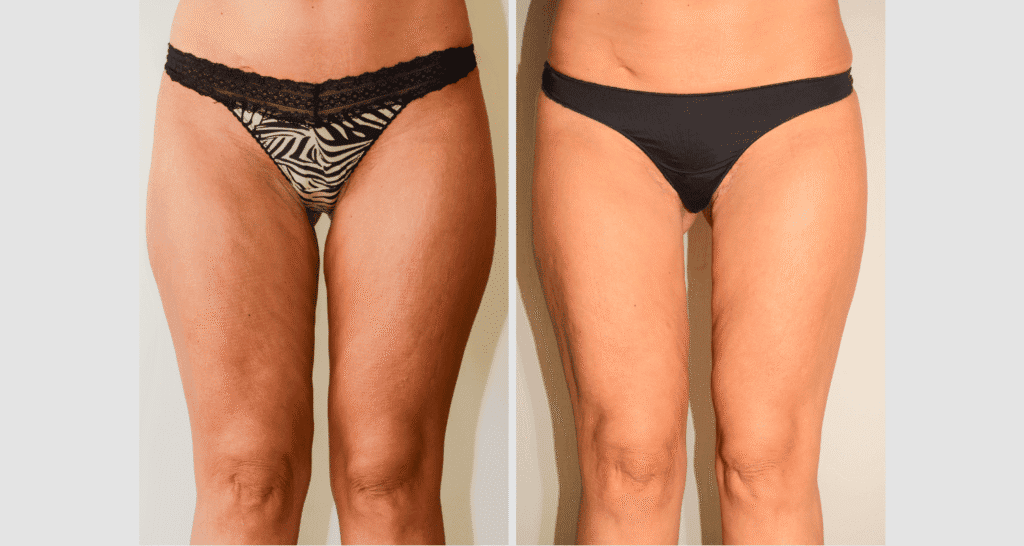 Vorher/Nachher Ergebnis: Oberschenkelstraffung