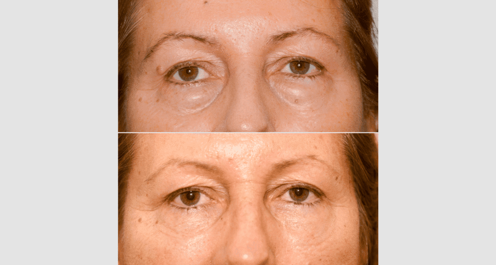 Vorher-Nachher Vergleich einer Hautstraffung im Gesicht.