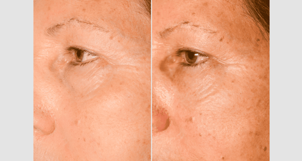 Vorher-Nachher Vergleich einer Hautverjüngung bei türkof.at.