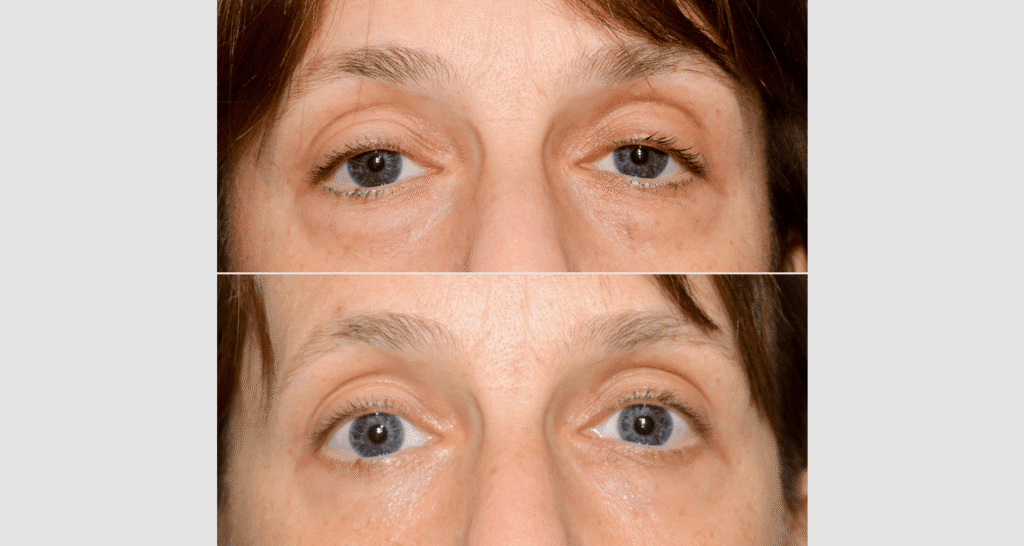 Vorher-nachher Vergleich der Haut im Gesichtsbereich, Fokus auf Augenpartie.