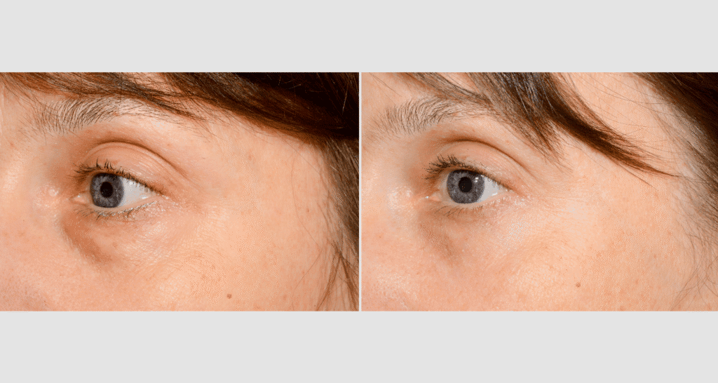 Vergleich der Haut vor und nach einer Hautbehandlung, Hautbildverbesserung sichtbar.