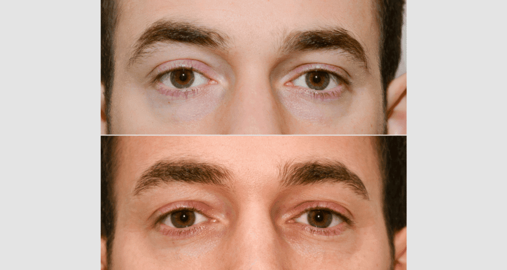 Nahaufnahme eines männlichen Gesichts vor und nach Hautbehandlung.