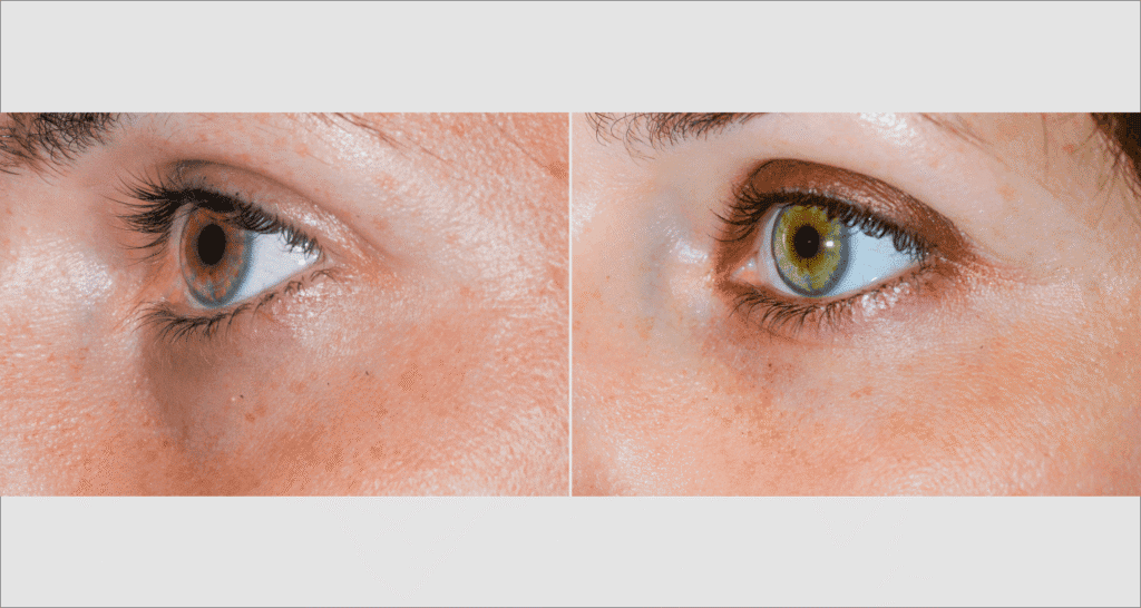 Nahaufnahme eines menschlichen Auges vor und nach einer Behandlung.