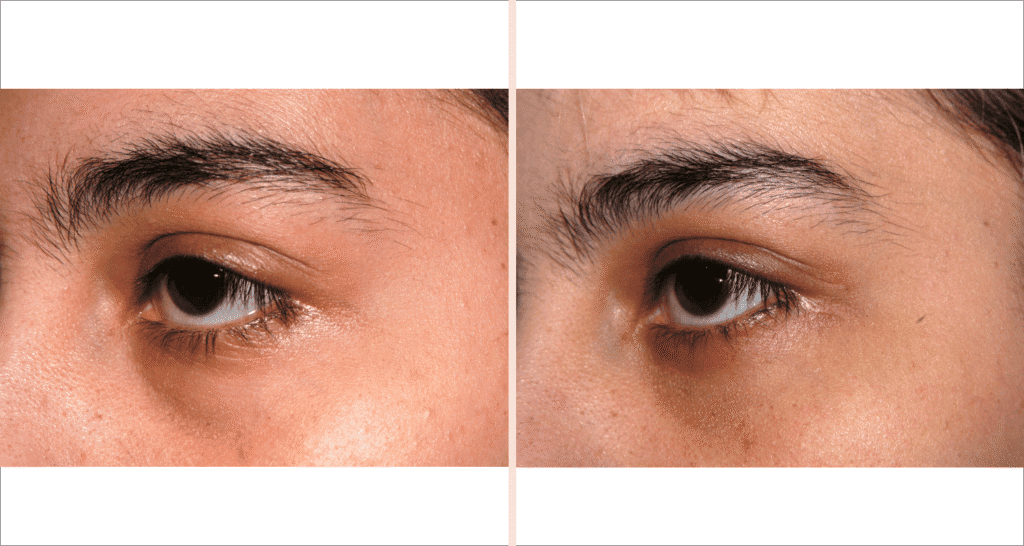 Vorher/Nachher Ergebnis: Traenensack Augenringkorrektur