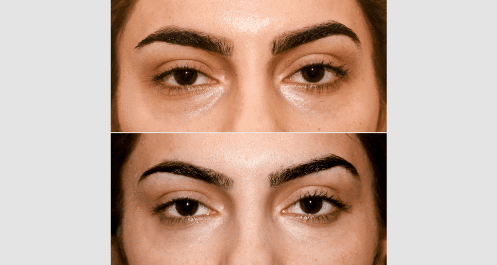 Nahaufnahme von Augenbrauen vor und nach Hautbehandlung, Hautbildverbesserung sichtbar.