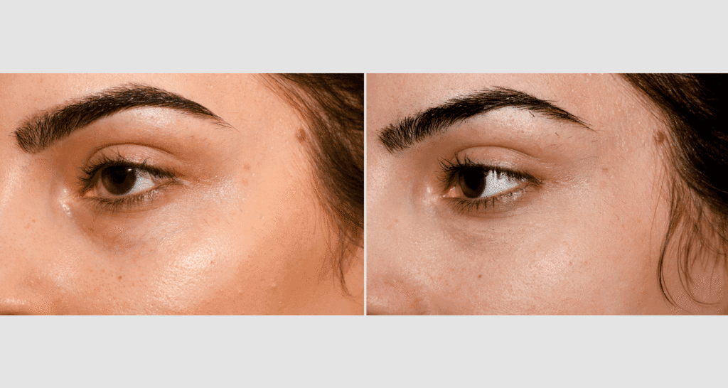 Close-up of a woman's face showing clear skin before and after skincare treatment.