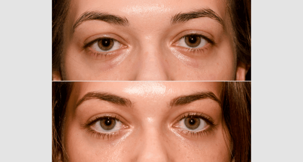 Vorher-nachher Vergleich der Hautpflege bei Augenringen und Hautbildverbesserung.