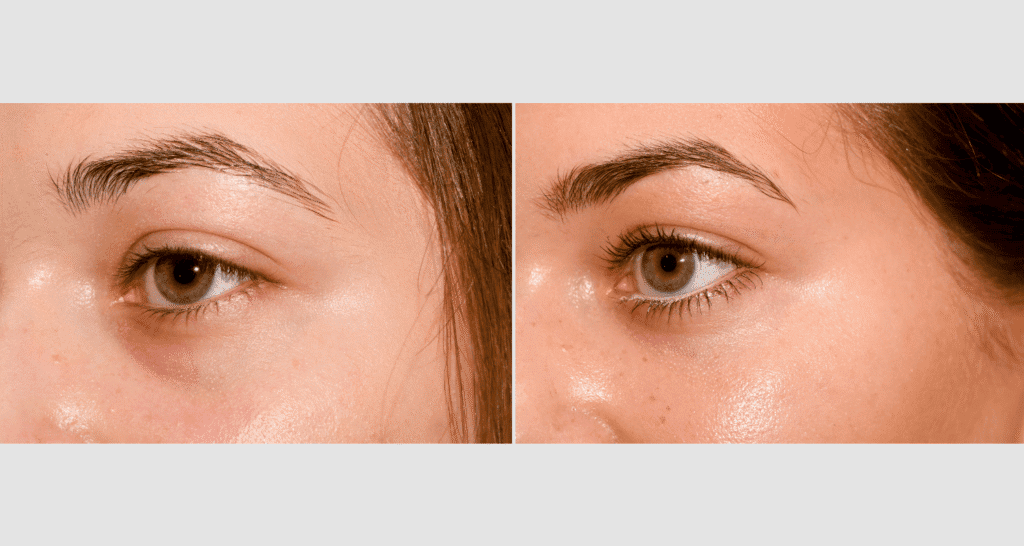 Nahaufnahme eines Gesichts mit Akne und Unreinheiten, Hautpflege-Tipps.