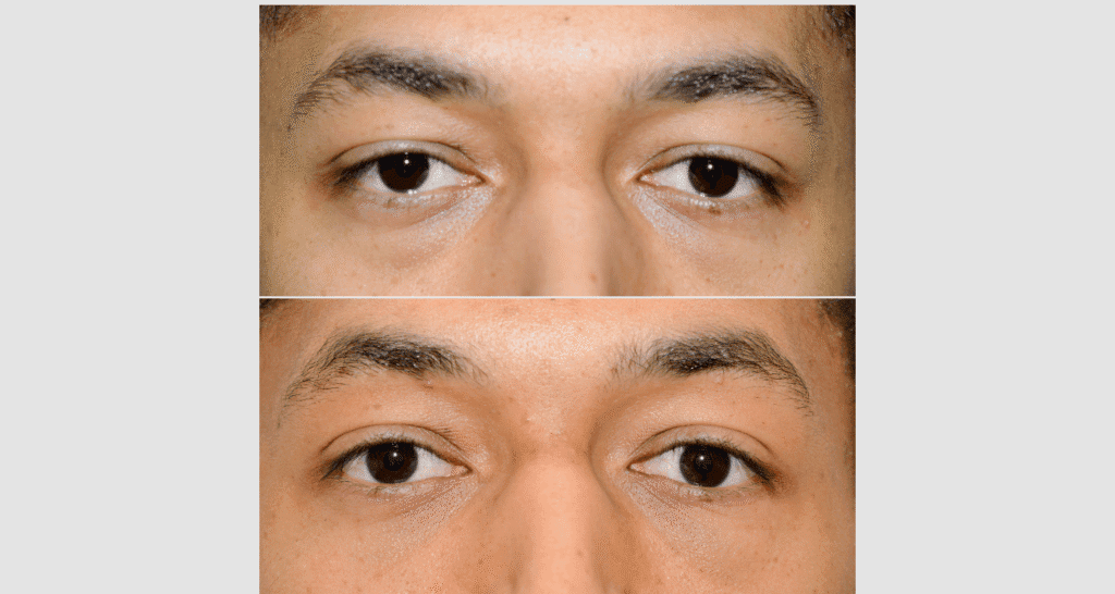 Nahaufnahme von menschlichen Augen vor und nach einer kosmetischen Behandlung.