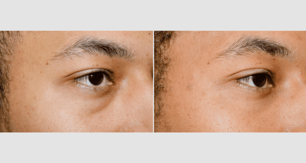 Nahaufnahme von Augenringen vor und nach Hautbehandlung.